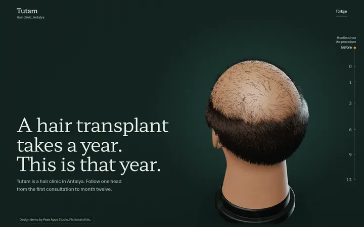 The clinic demo on a laptop: a 3D head with thinning hair on the crown, next to the headline A hair transplant takes a year.